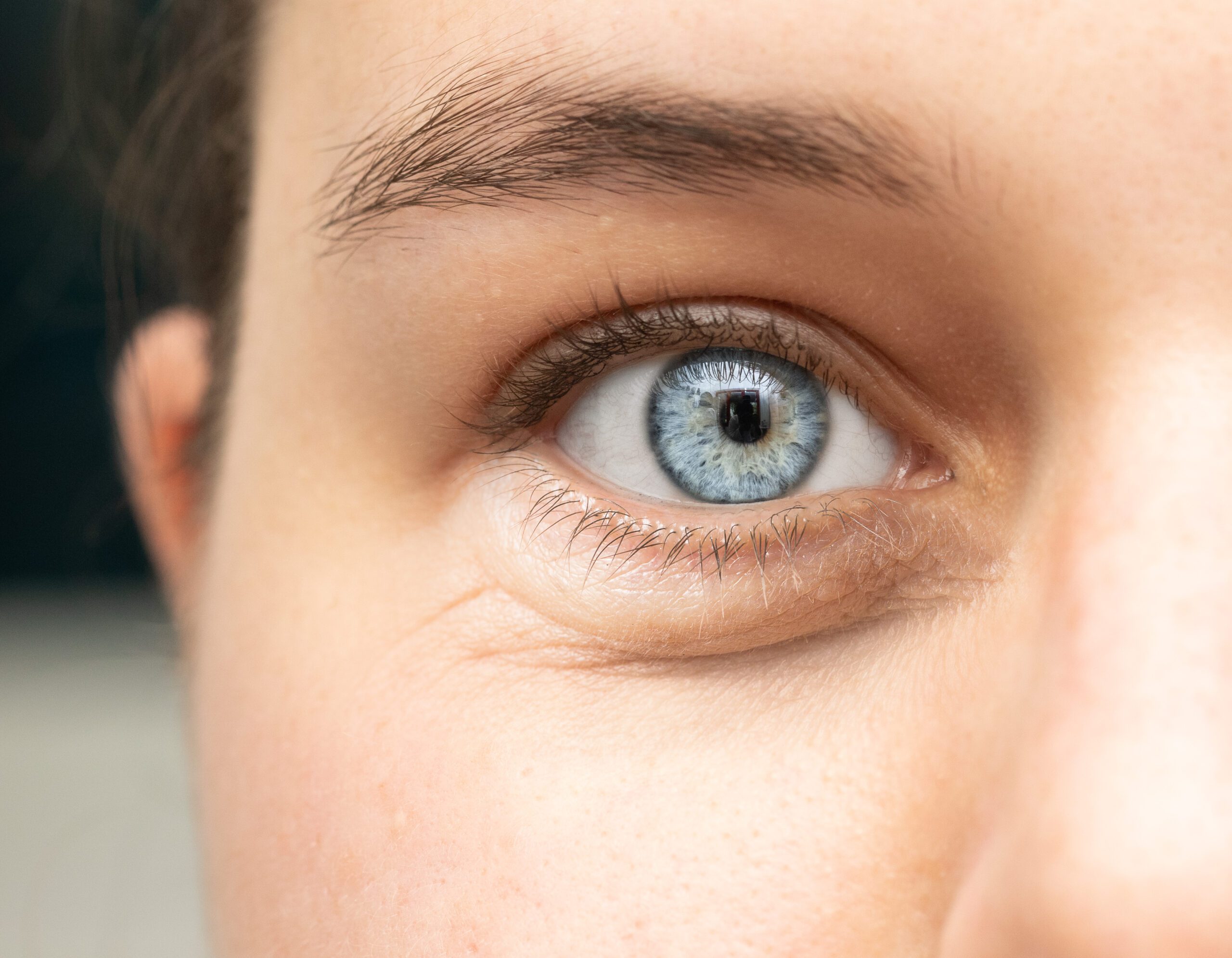 Blefaroplastia

