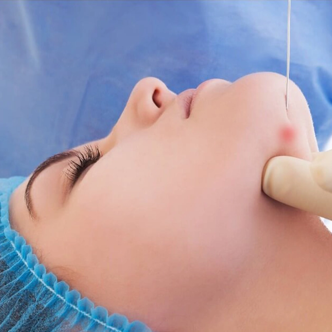 Endolift